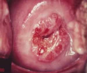 Причины возникновения эрозии шейк матки