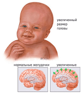 Накопление жидкости в тканях мозга