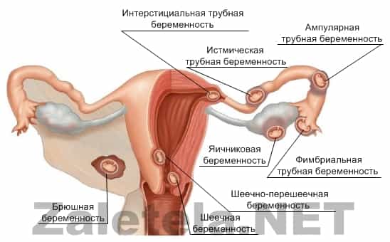 Беременность шеечная