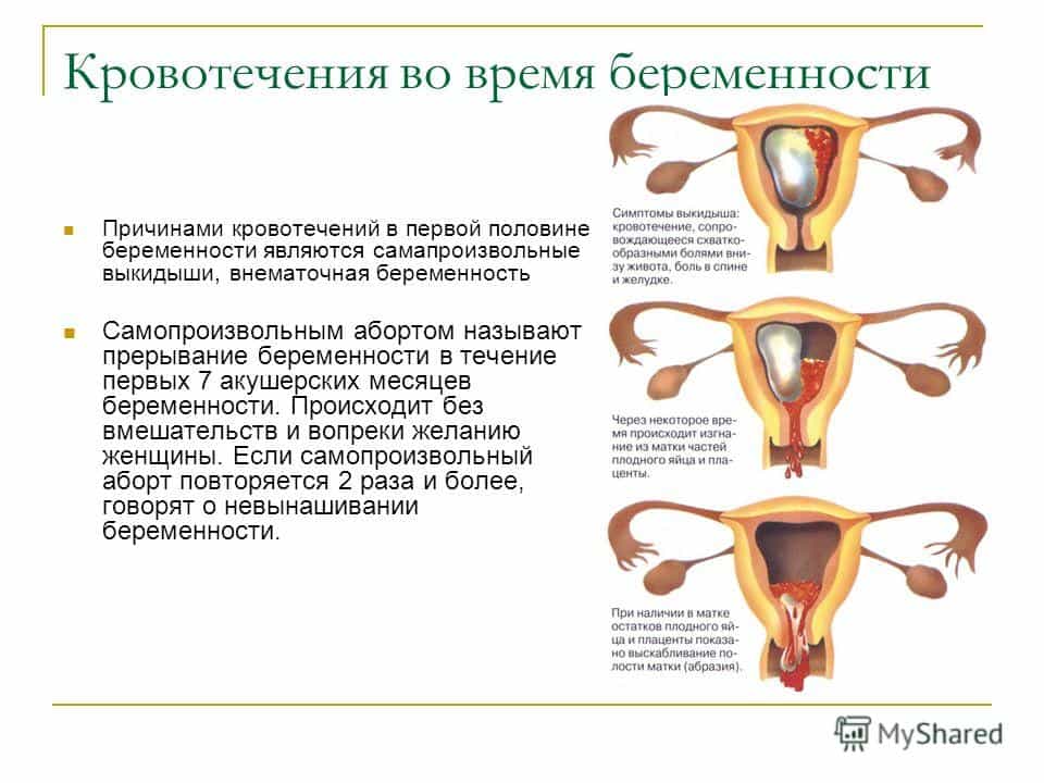 Кровотечение в первой половине беременности