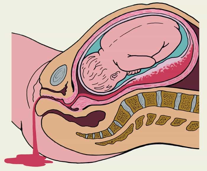 Кровотечение во второй половине беременности и родах