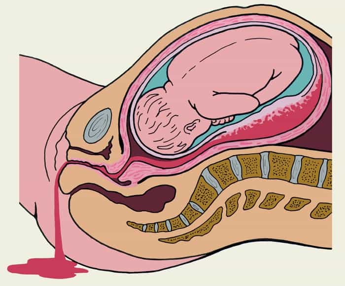 Преждевременная отслойка нормально расположенной плаценты