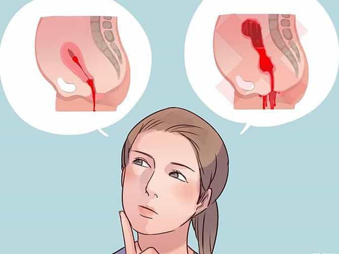 Кровотечения после родов
