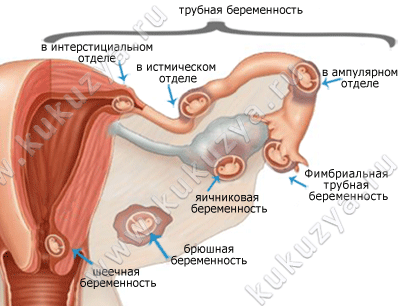 Беременность внематочная