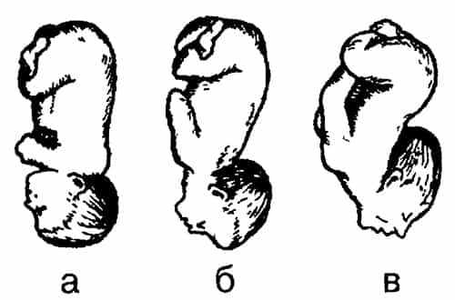 Предлежание плода головное неправильное