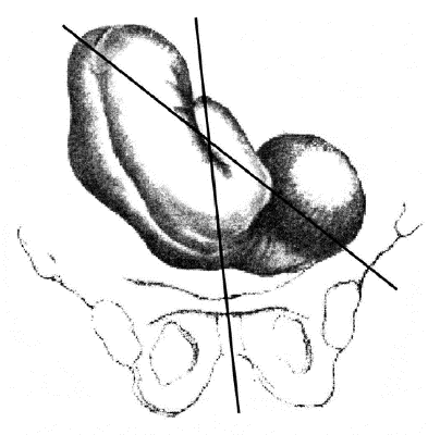 Положение плода косое