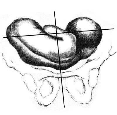 Положение плода  поперечное