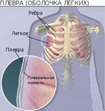 Плеврит