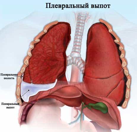 Плеврит