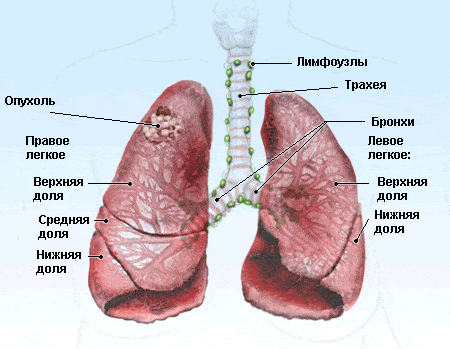 Рак лёгкого