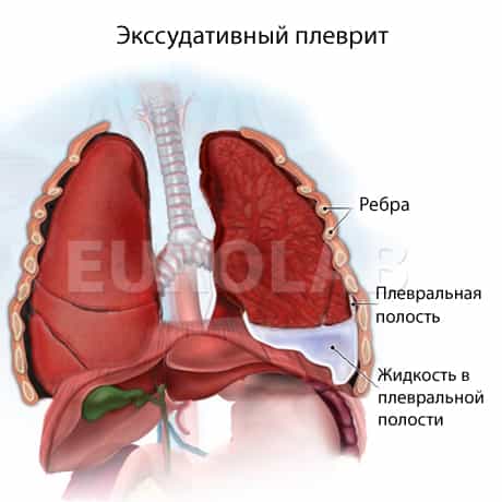 Плеврит туберкулезный (воспаление оболочек легкого)