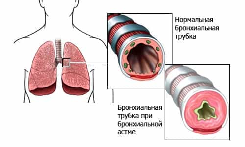 Бронхиальная астма