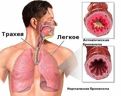 Бронхиальная астма