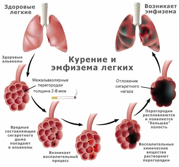 Эмфизема легких