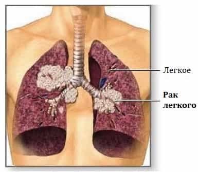Рак легких