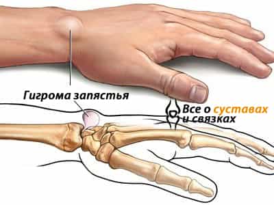 Гигрома запястья