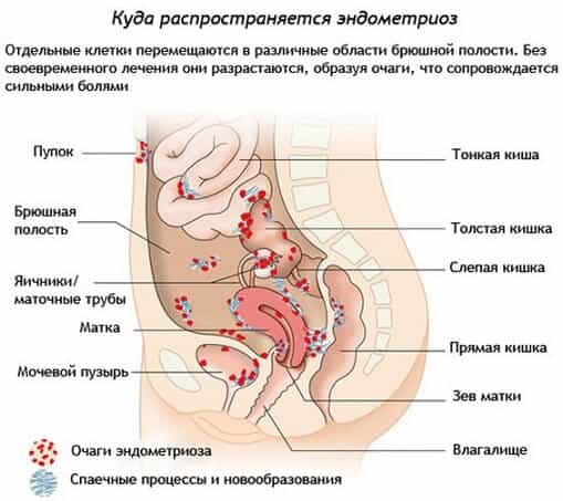 Эндометриоз