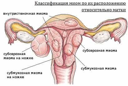 Классификация миом по расположению их относительно матки